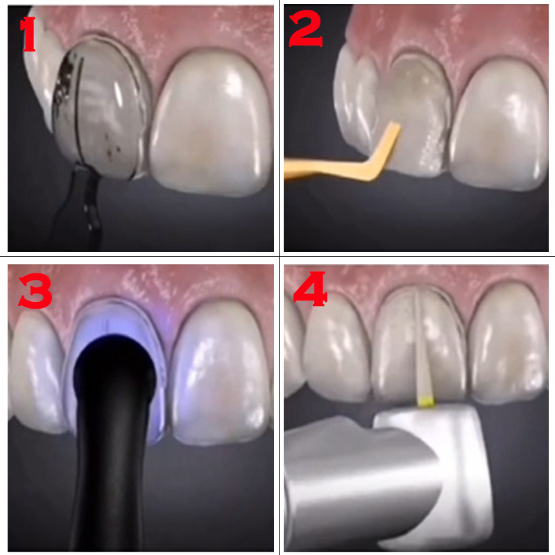 멸균 가능한 치과용 베니어 몰드, 앞니 미용 베니어,  - Teeth Whitening Moulds 리뷰 및 가격