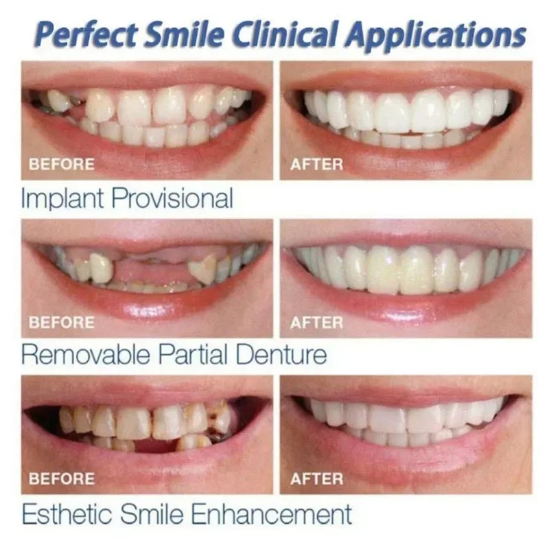 착용형 치아 보철 키트, 조절 가능한 미용용 치아 보철 - Teeth Whitening Kit 리뷰 및 가격