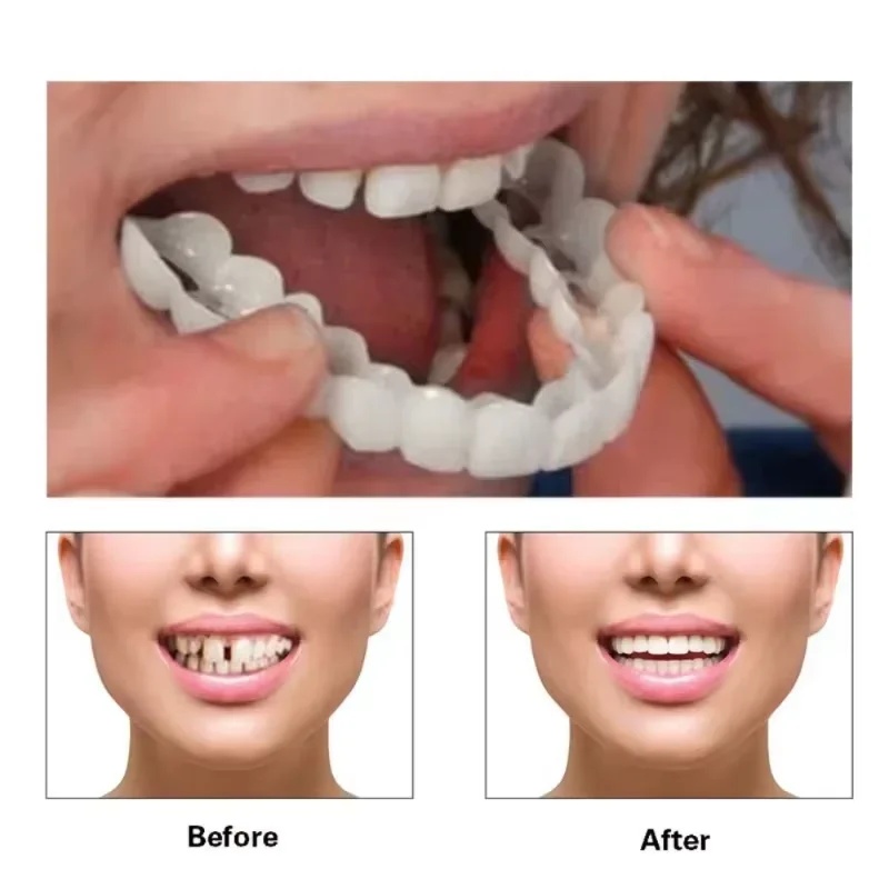 착용형 치아 보철 키트, 조절 가능한 미용용 치아 보철 - Teeth Whitening Kit 리뷰 및 가격